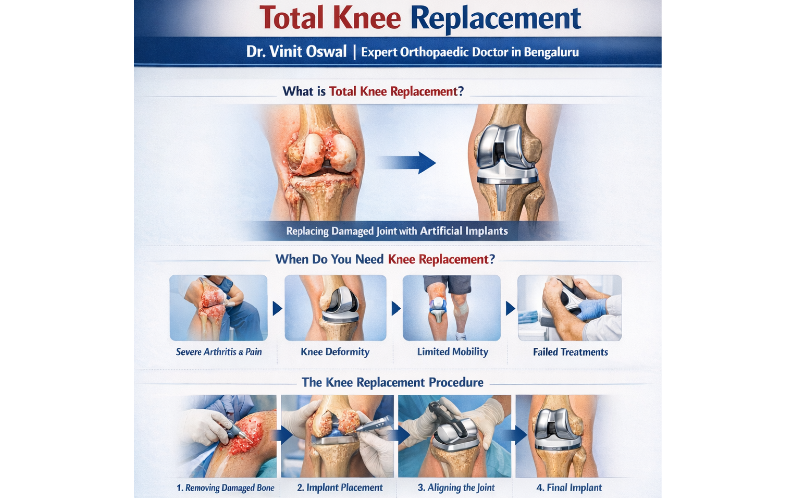 Total Knee Replacement
